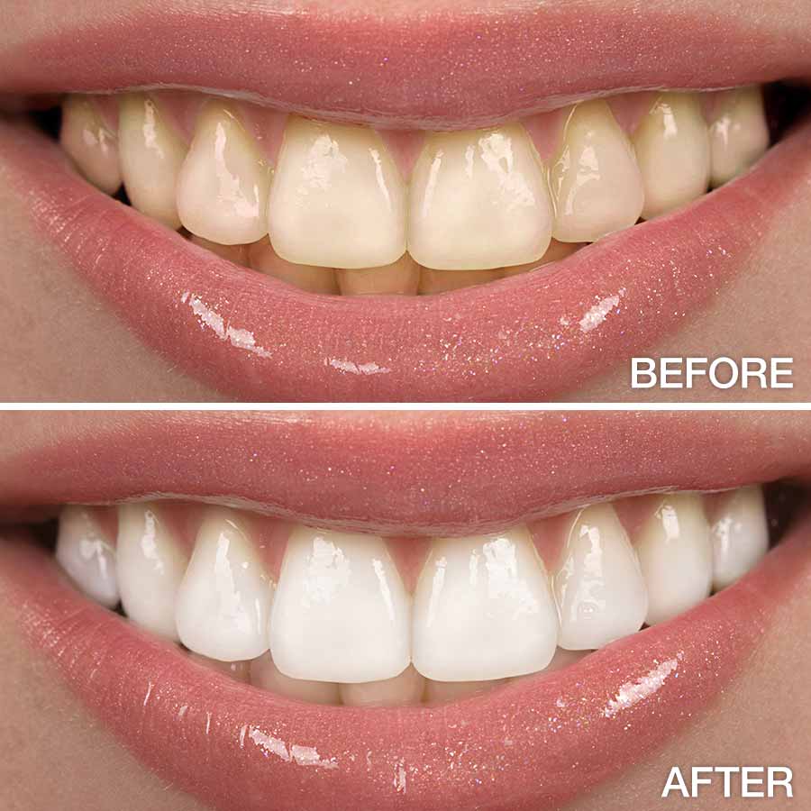 before-after-teeth-whitening
