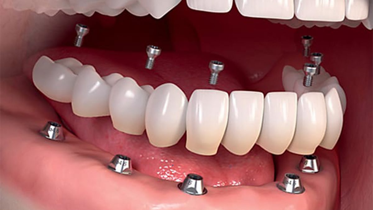 best root canal treatment in Zirakpur