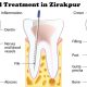 root canal treatment in Zirakpur