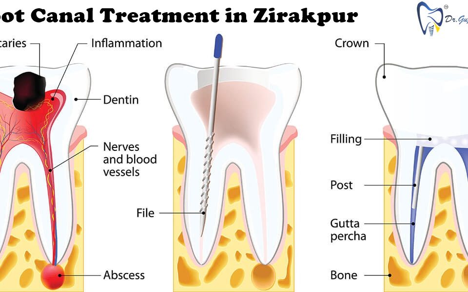 root canal treatment in Zirakpur