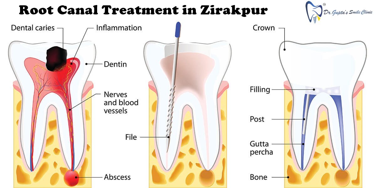 root canal treatment in Zirakpur