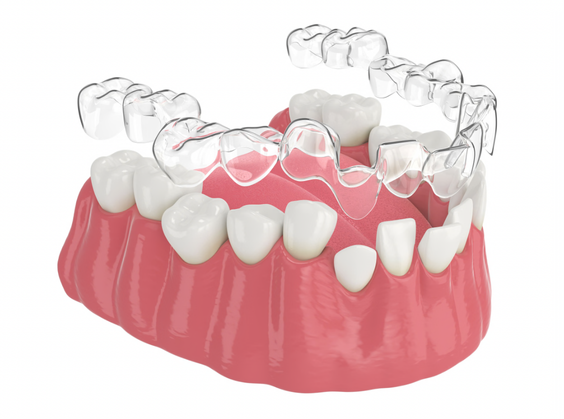 Clear aligners for straightening teeth at Dr. Gupta's Smile Clinic, Zirakpur