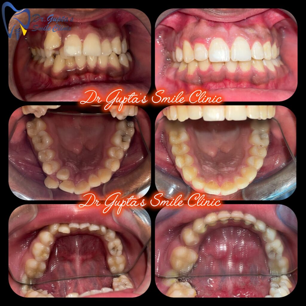 Braces treatment result at Dr. Gupta's Smile Clinic, Zirakpur