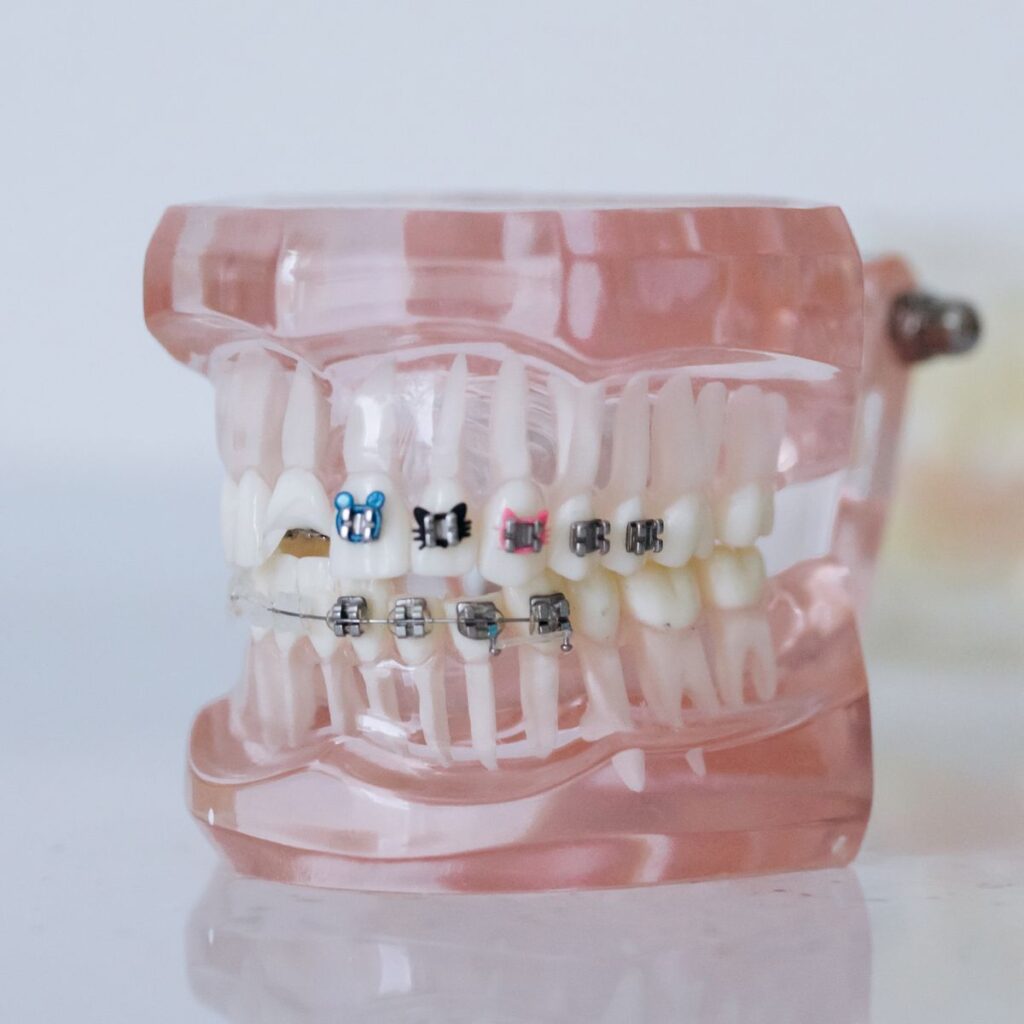 Dental model with metal braces on the teeth