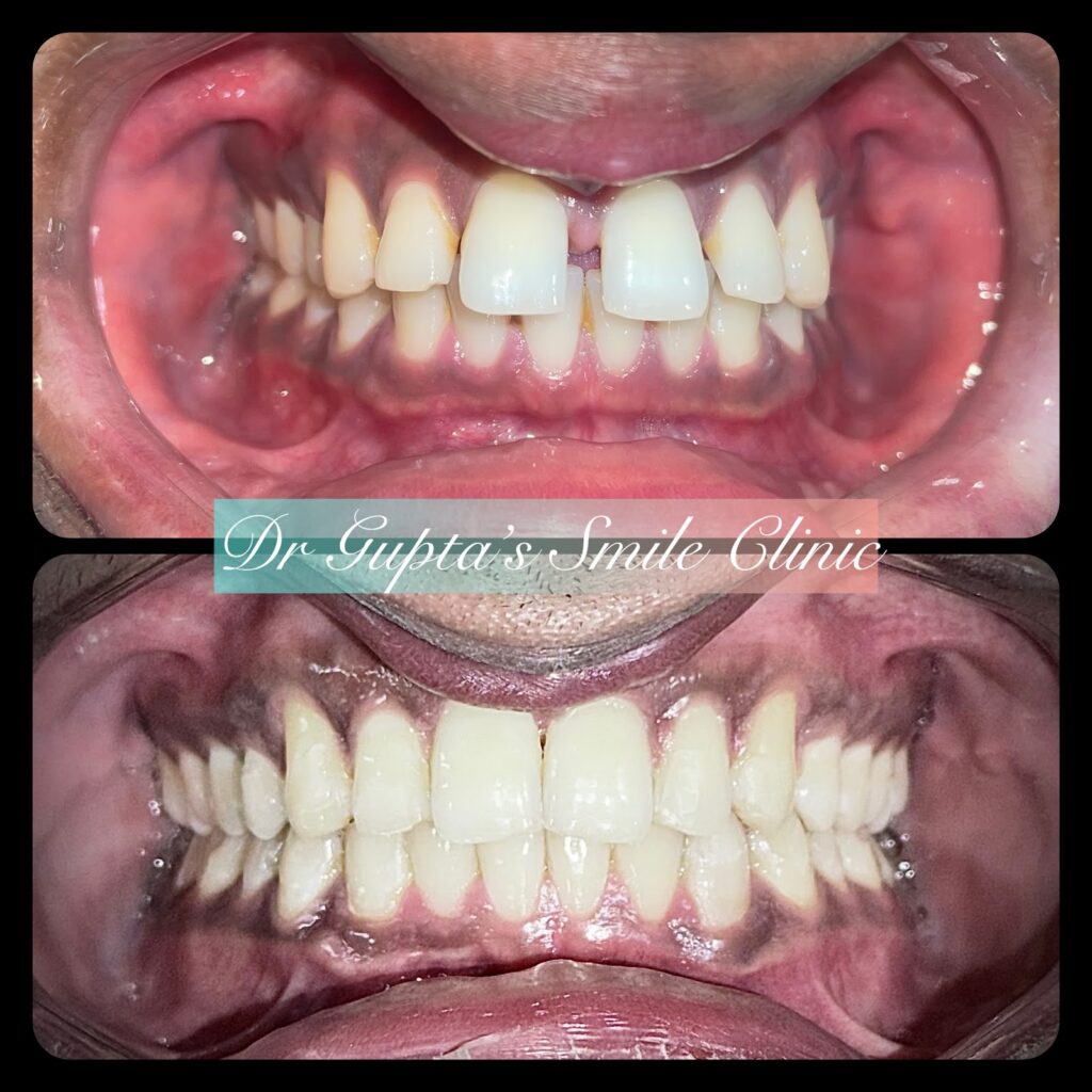 Clear aligner treatment before and after at Dr. Gupta's Smile Clinic