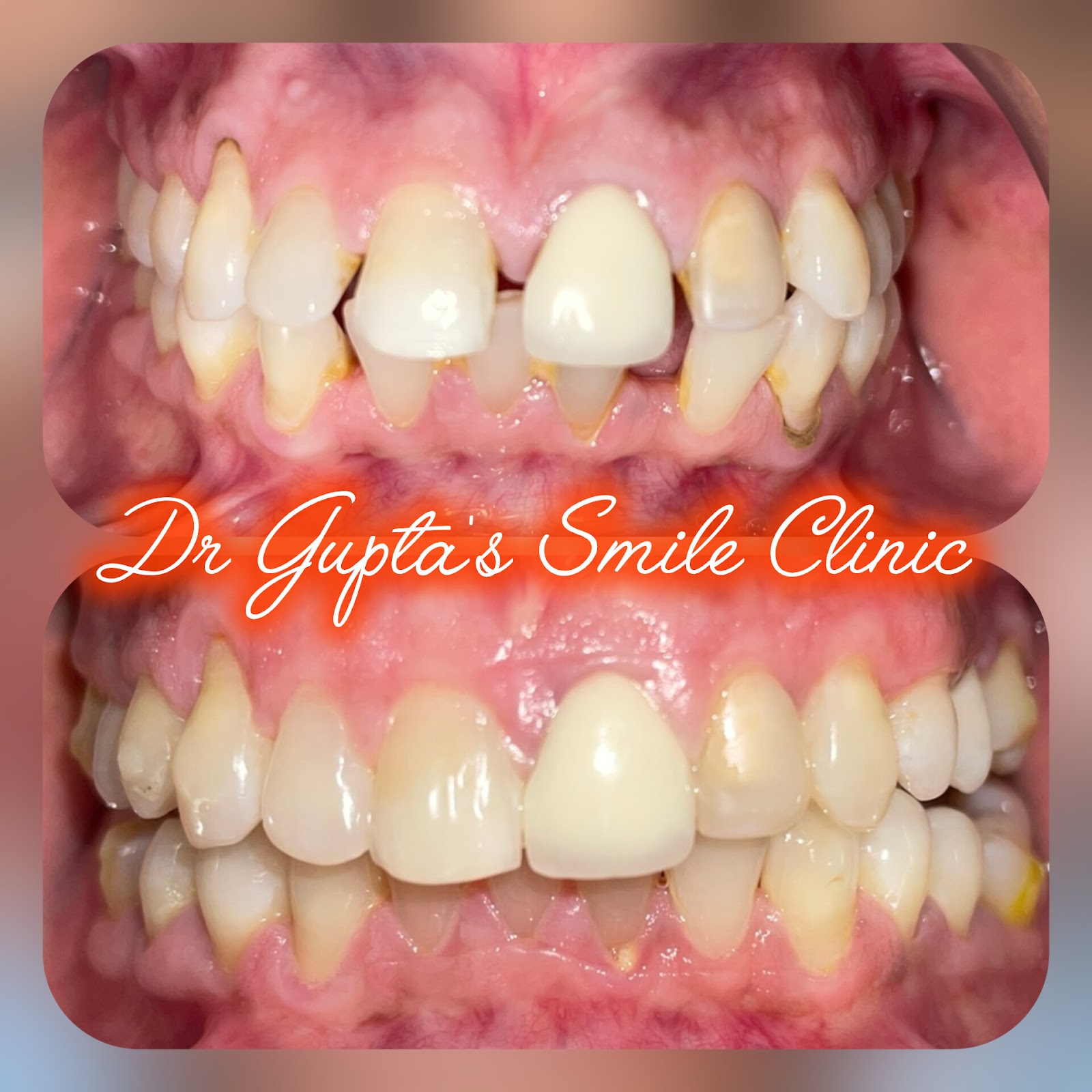 Clear aligners before and after at Dr. Gupta's Smile Clinic