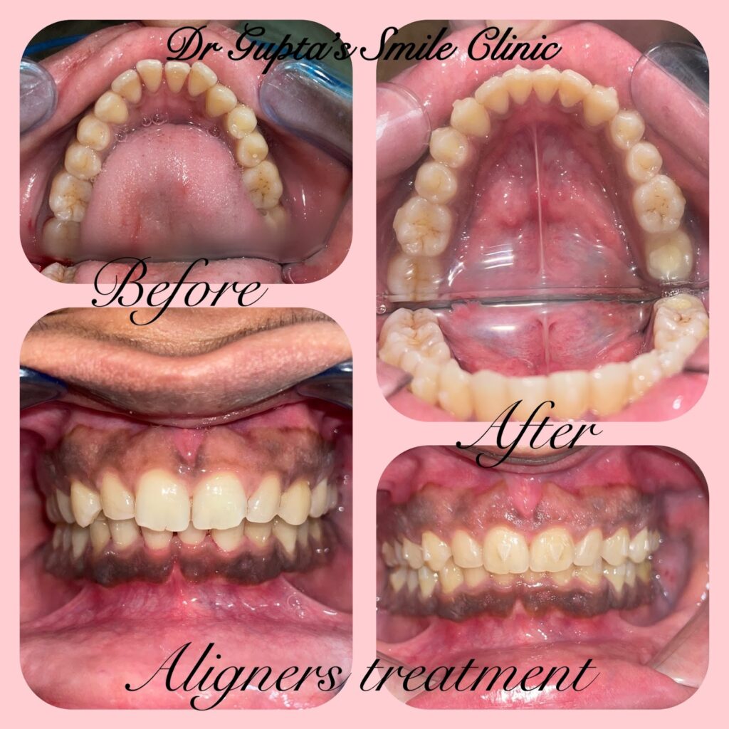 Teeth straightened with clear aligners, before and after