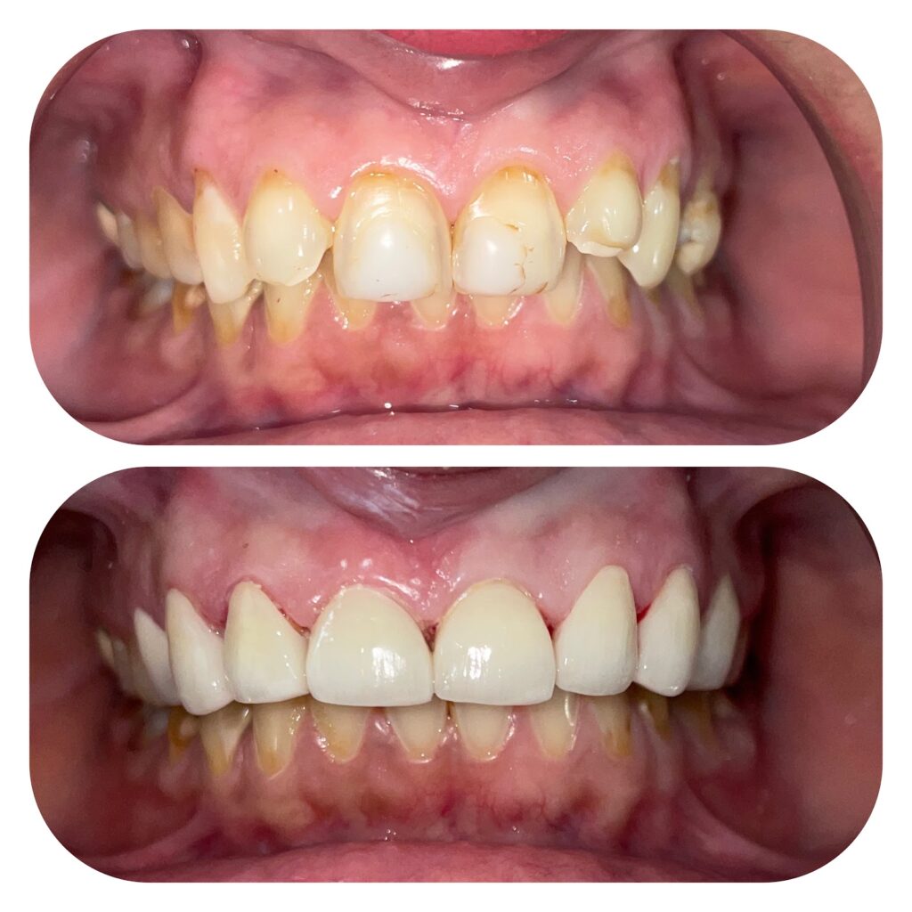 Cosmetic crowns before and after at Dr. Gupta's Smile Clinic, Zirakpur