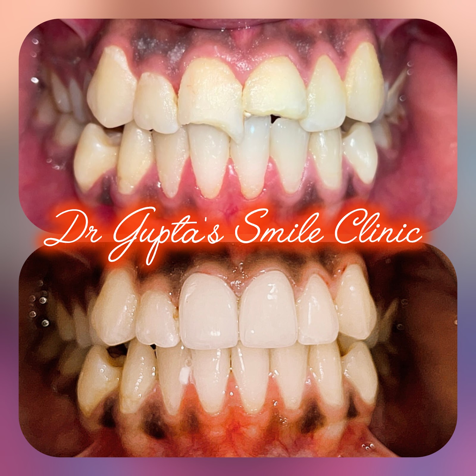 Front teeth cosmetic crowns result at Dr. Gupta's Smile Clinic