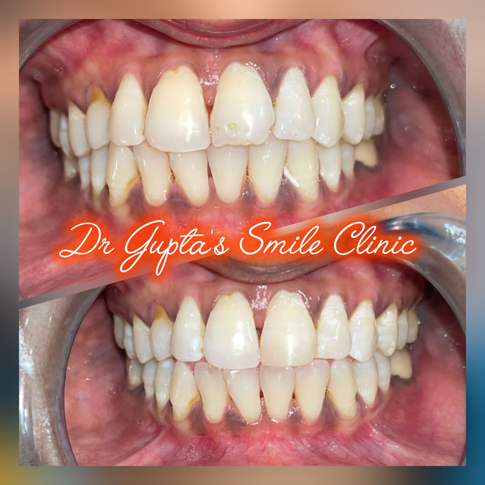 Smile improved with cosmetic dentistry, before and after