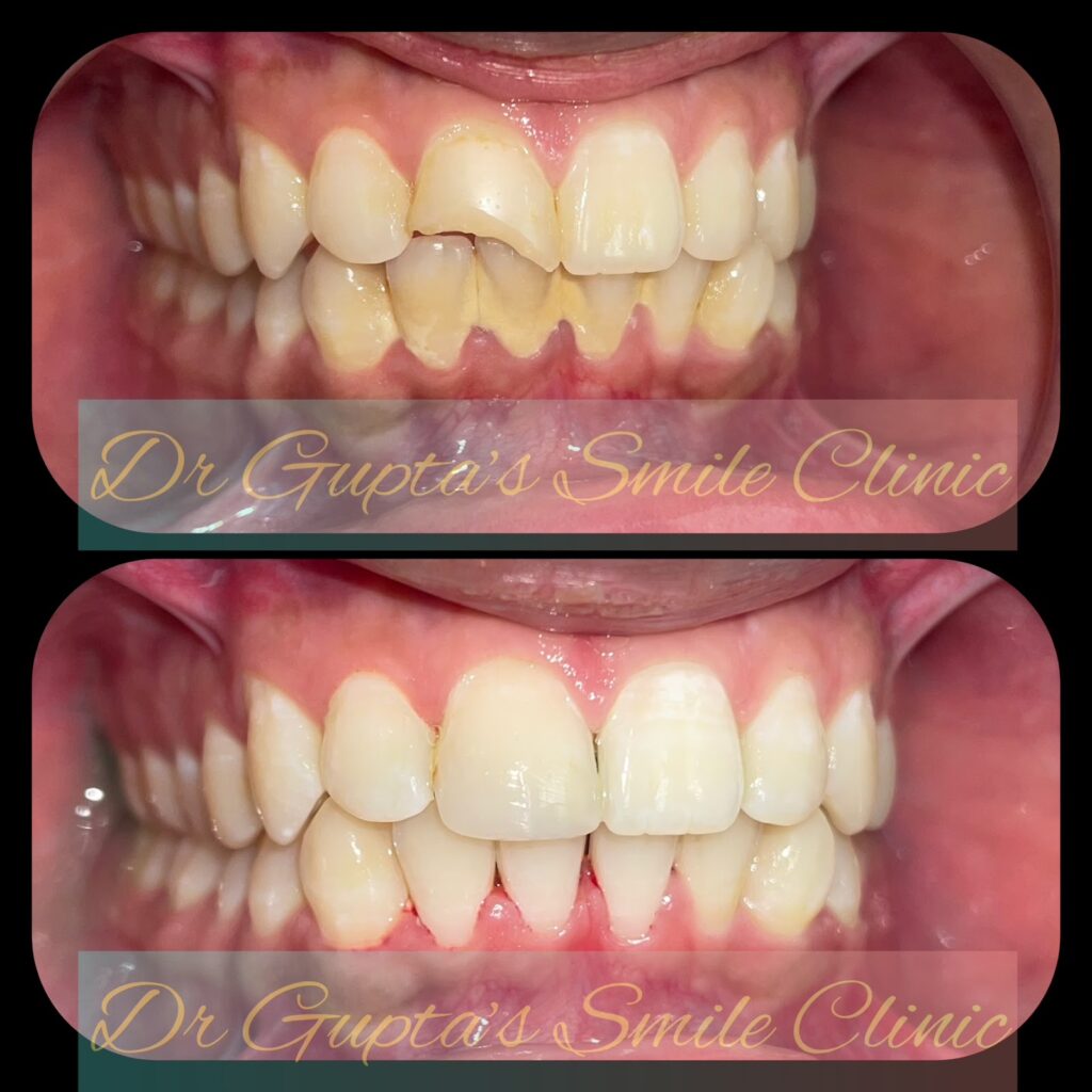 Tooth-coloured cosmetic filling, before and after