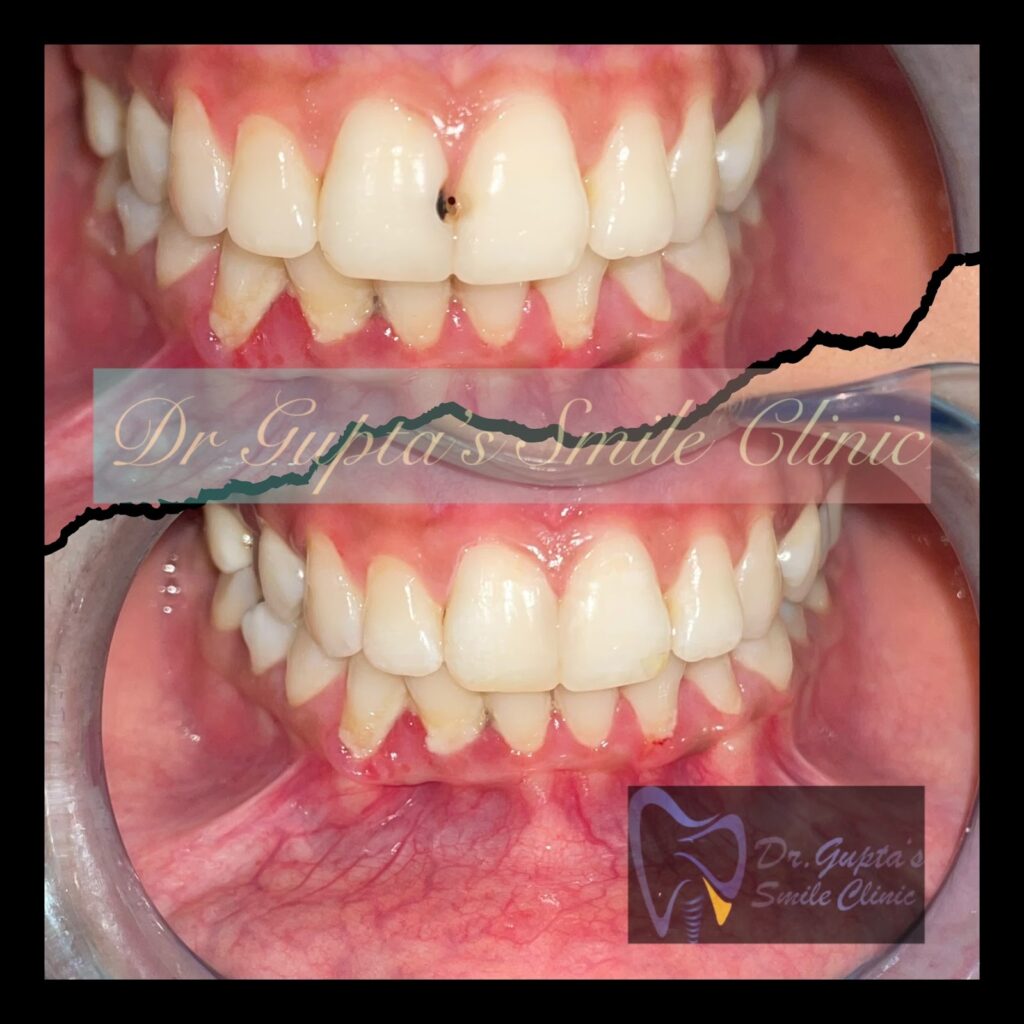 Cosmetic filling result at Dr. Gupta's Smile Clinic, Zirakpur