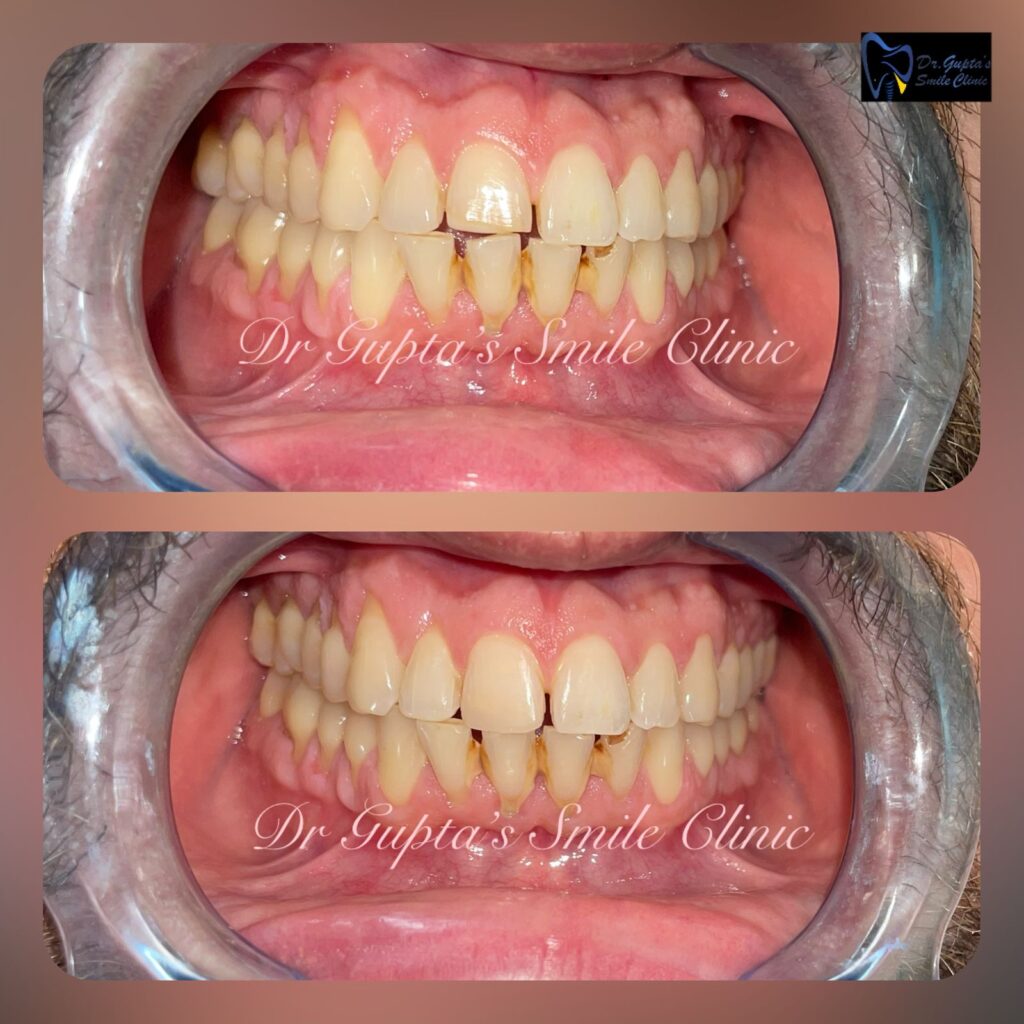 Front tooth cosmetic filling, before and after