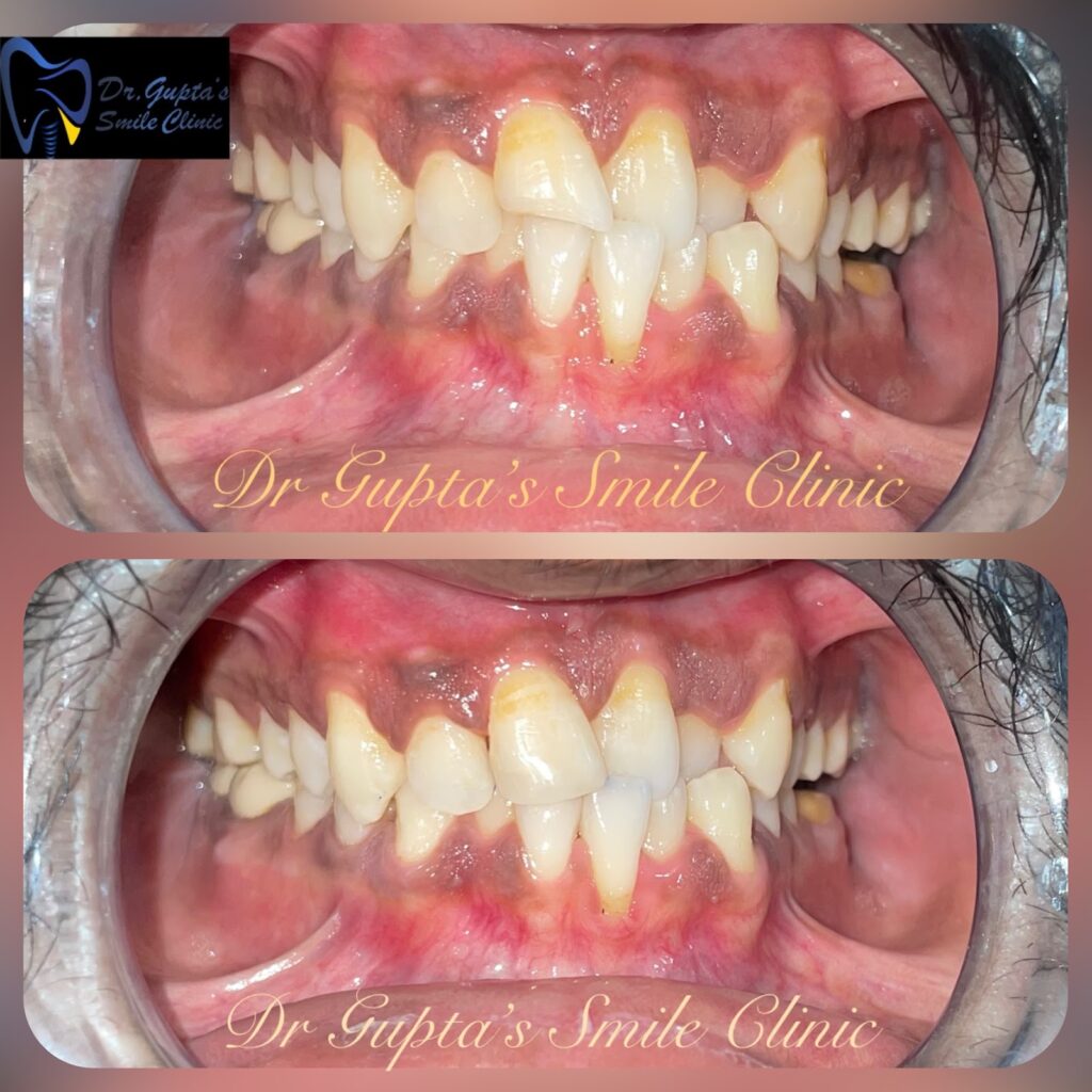 Cosmetic dentistry result at Dr. Gupta's Smile Clinic
