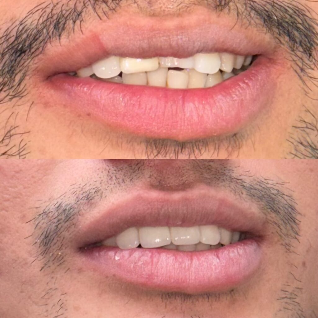 Cosmetic smile makeover with crowns, before and after