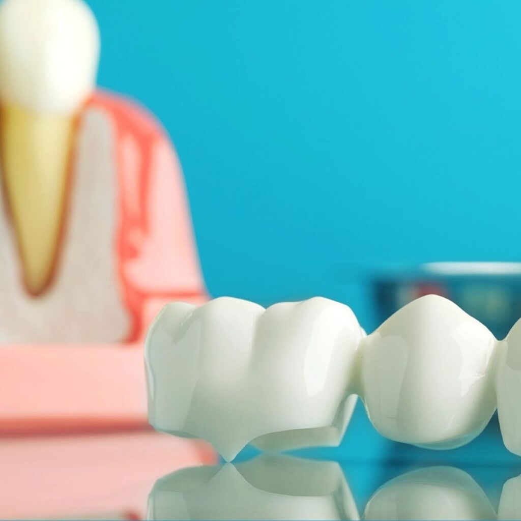 Dental crown and bridge close-up