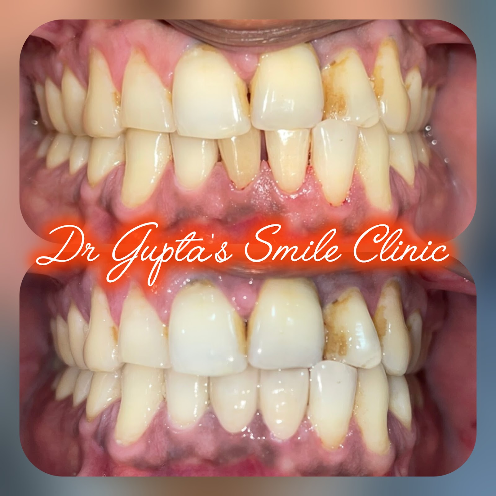 Cosmetic dental crowns before and after at Dr. Gupta's Smile Clinic