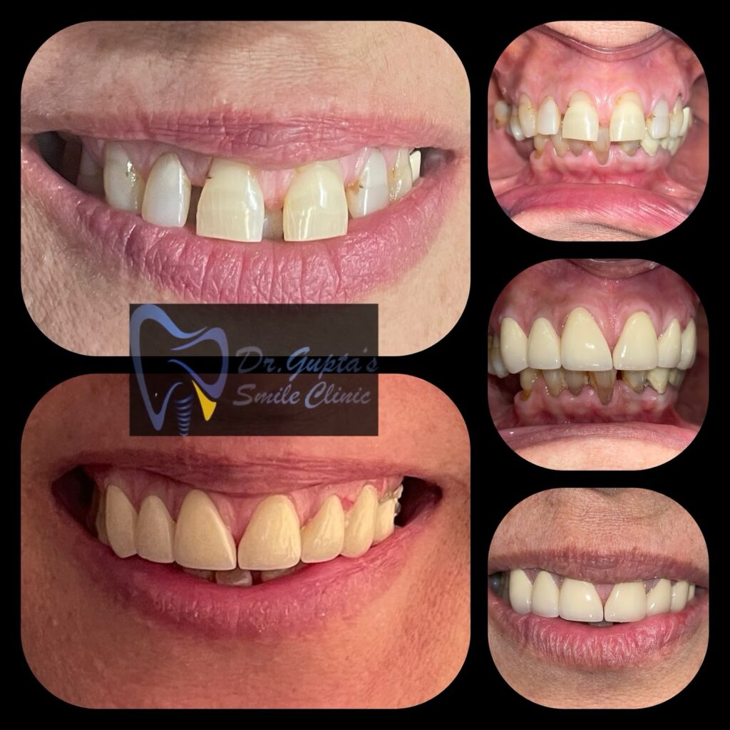 Dental crowns before and after at Dr. Gupta's Smile Clinic, Zirakpur