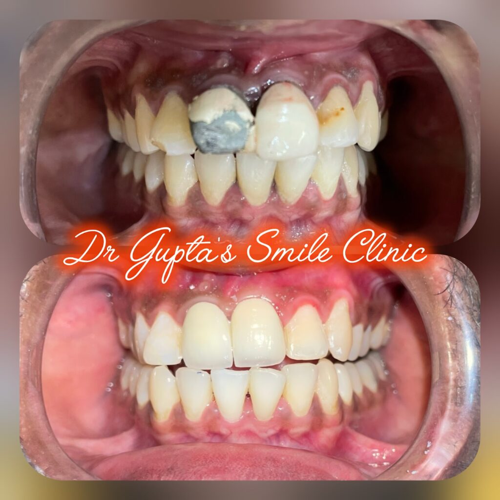 Crowns and bridges result at Dr. Gupta's Smile Clinic, Zirakpur