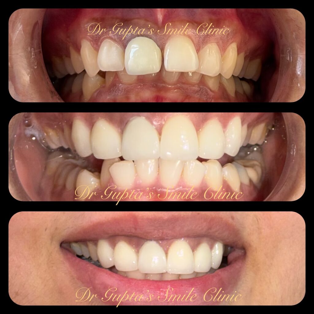 Dental crowns result at Dr. Gupta's Smile Clinic
