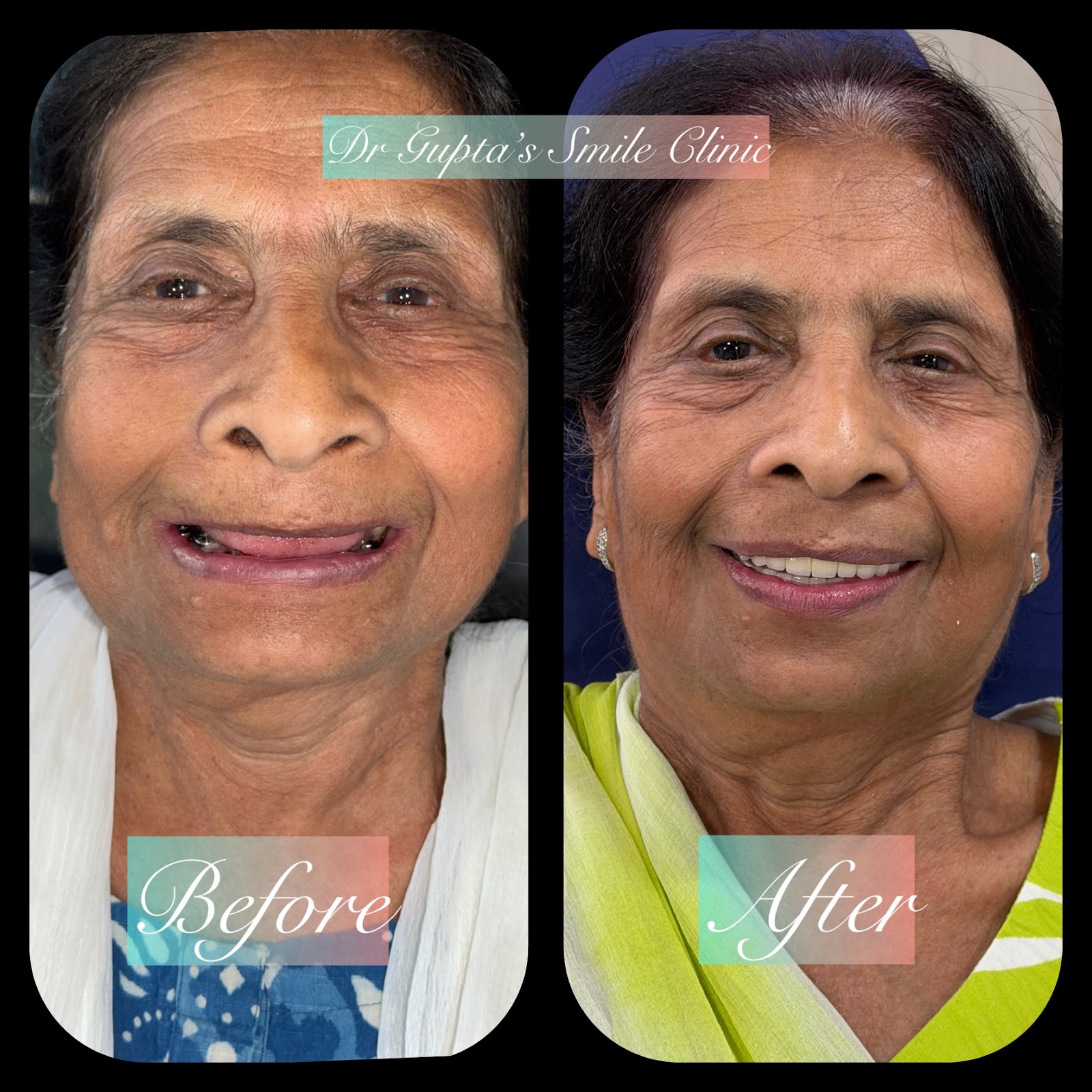 Dental implants smile makeover for an 82-year-old patient at Dr. Gupta's Smile Clinic