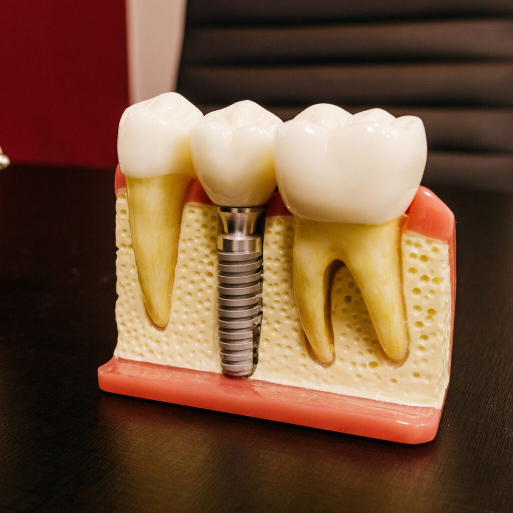 Dental implant model showing an implant post and crown