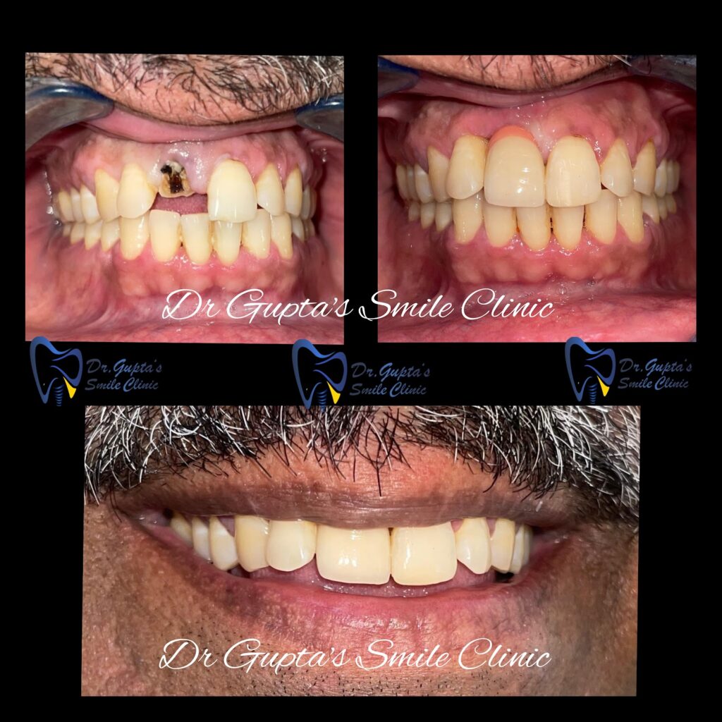 Dental implants before and after at Dr. Gupta's Smile Clinic, Zirakpur