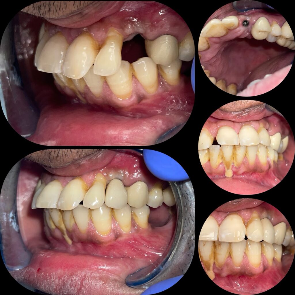 Dental implant result at Dr. Gupta's Smile Clinic, Zirakpur