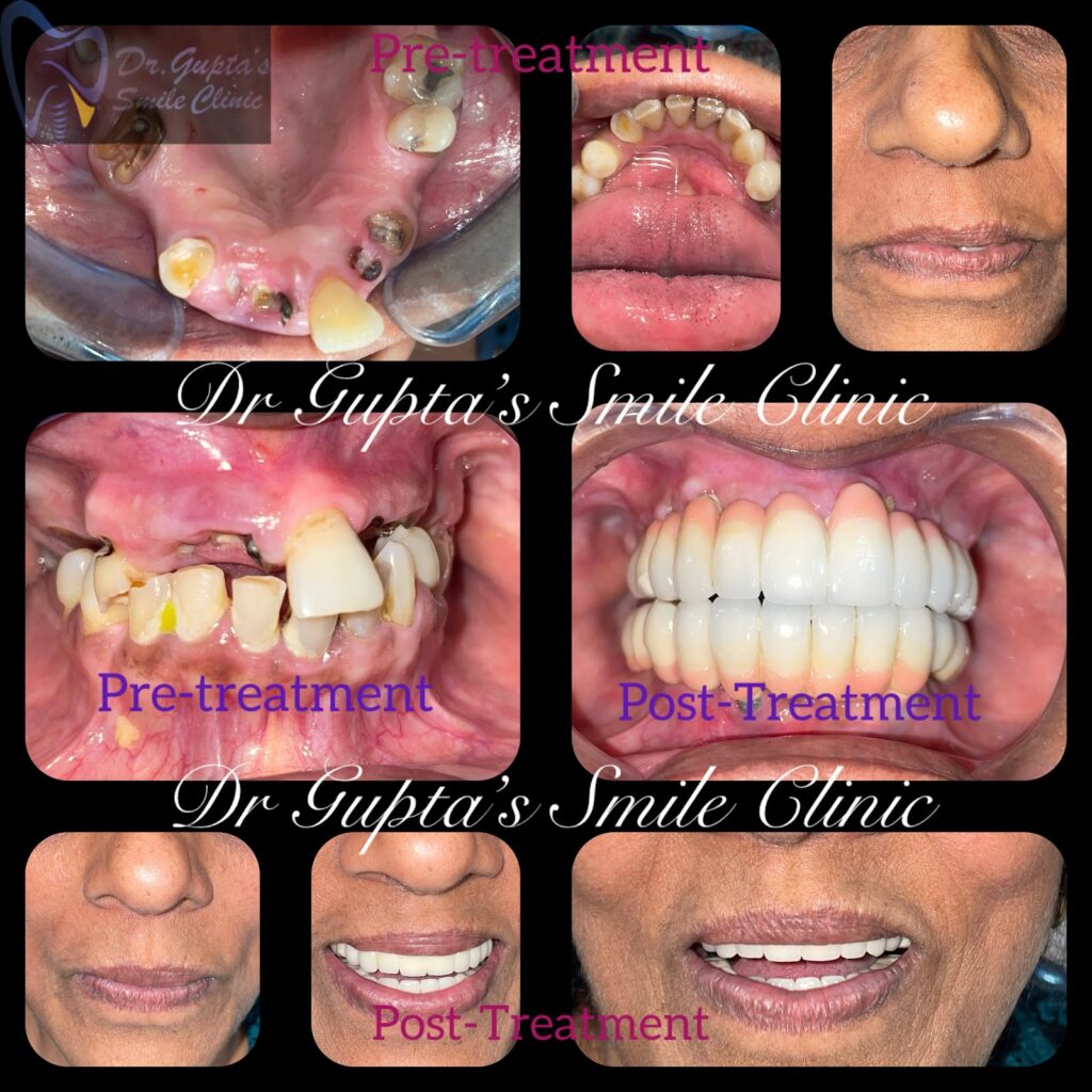 Smile restored with dental implants, before and after