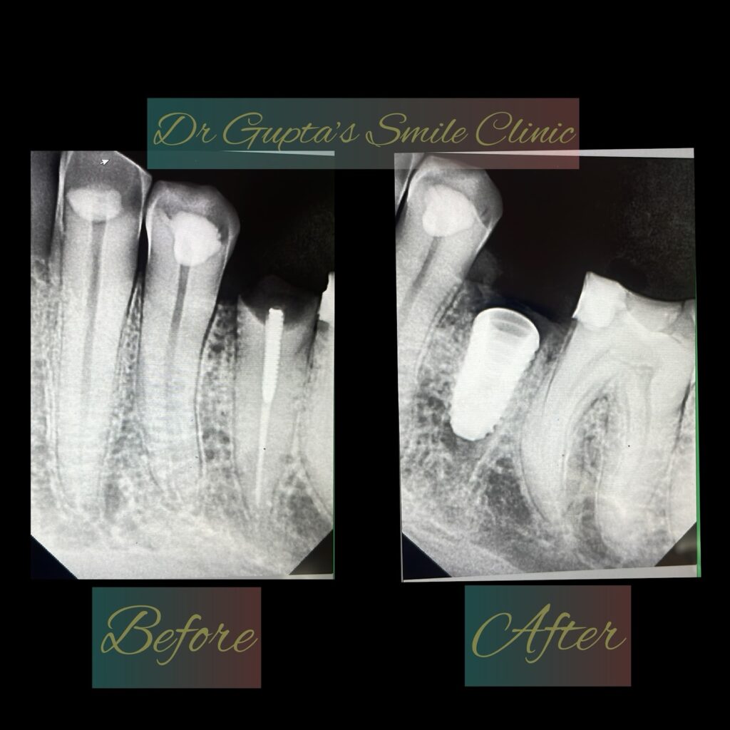 Missing teeth replaced with dental implants, before and after