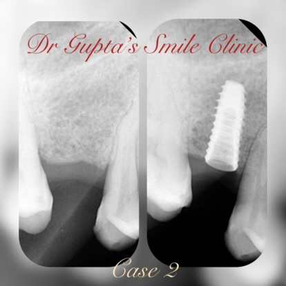 Dental implant crown result at Dr. Gupta's Smile Clinic