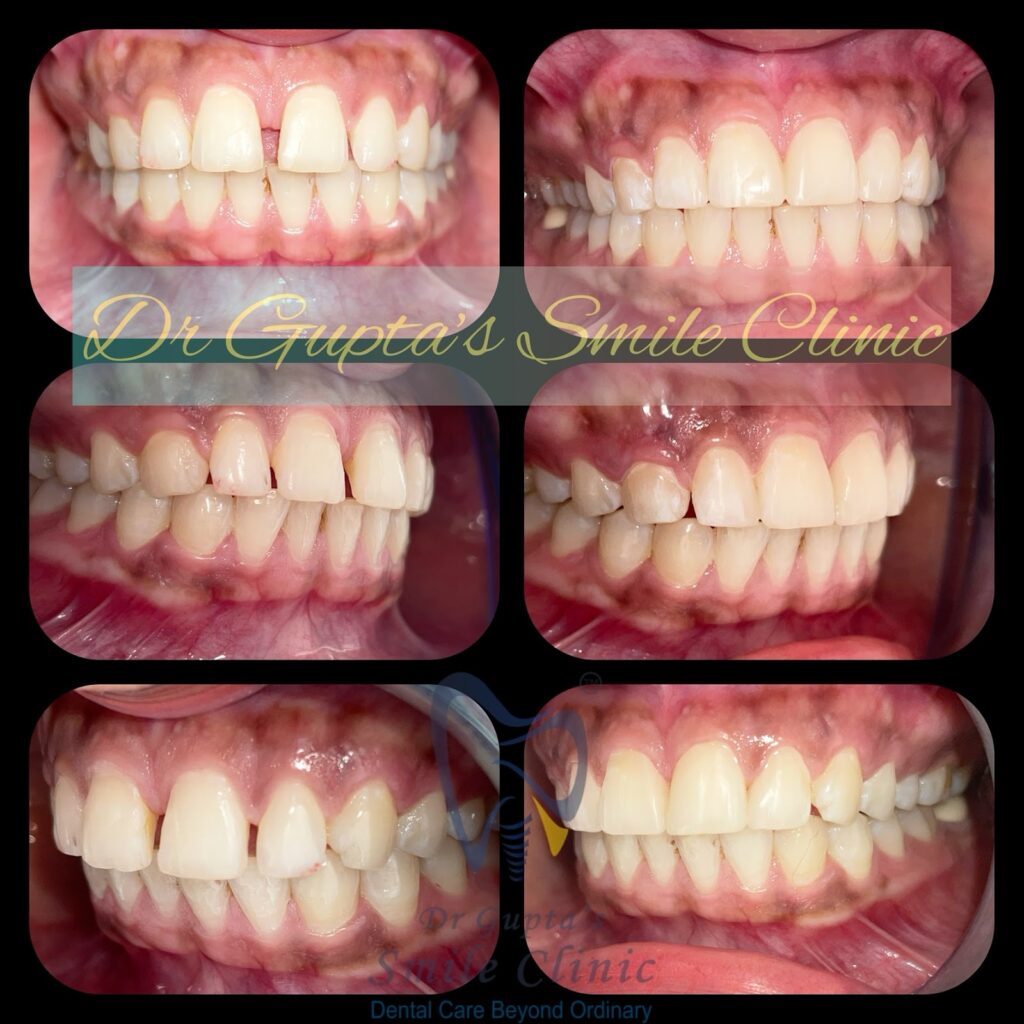 Gap between front teeth closed with cosmetic filling, before and after