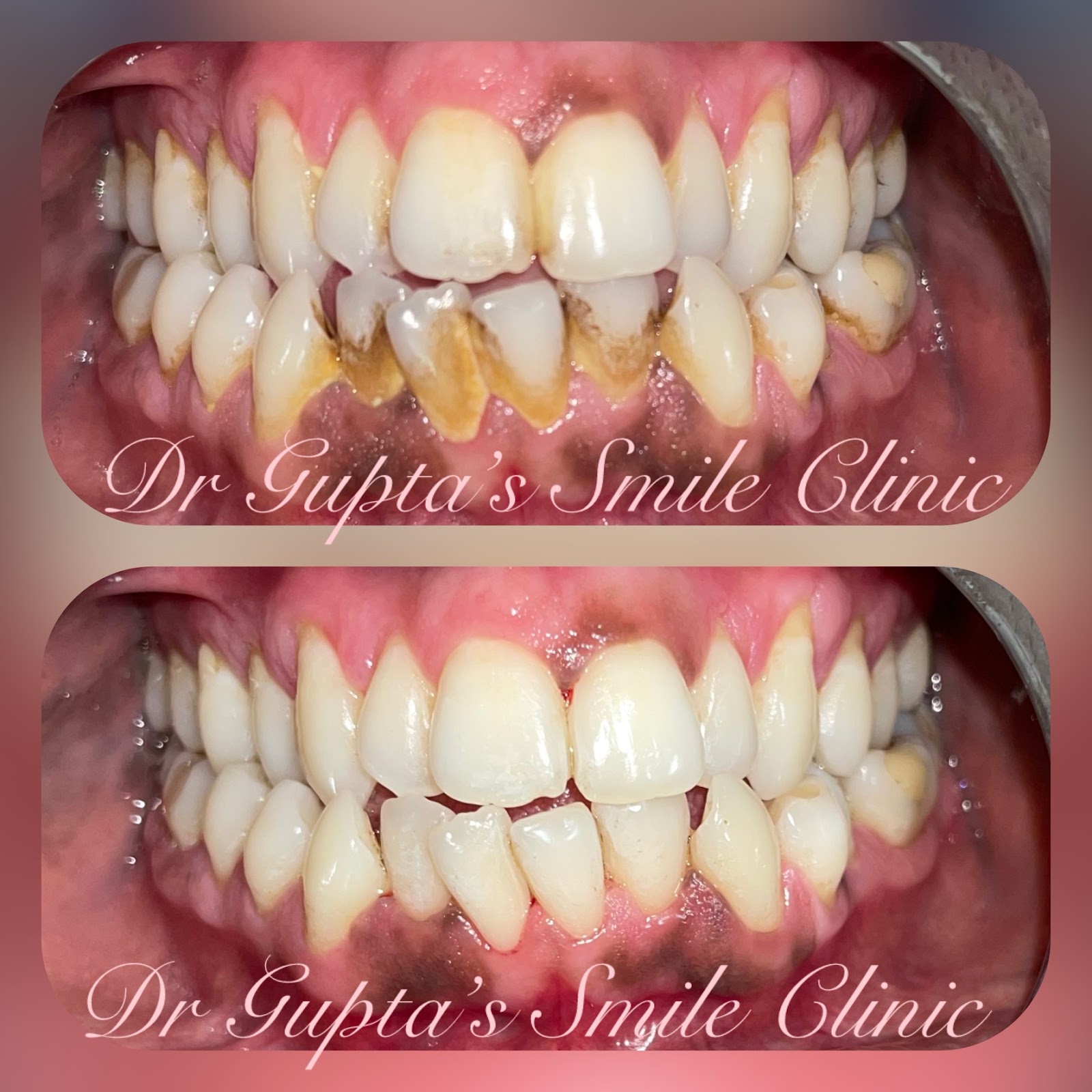 Scaling and gum treatment result at Dr. Gupta's Smile Clinic