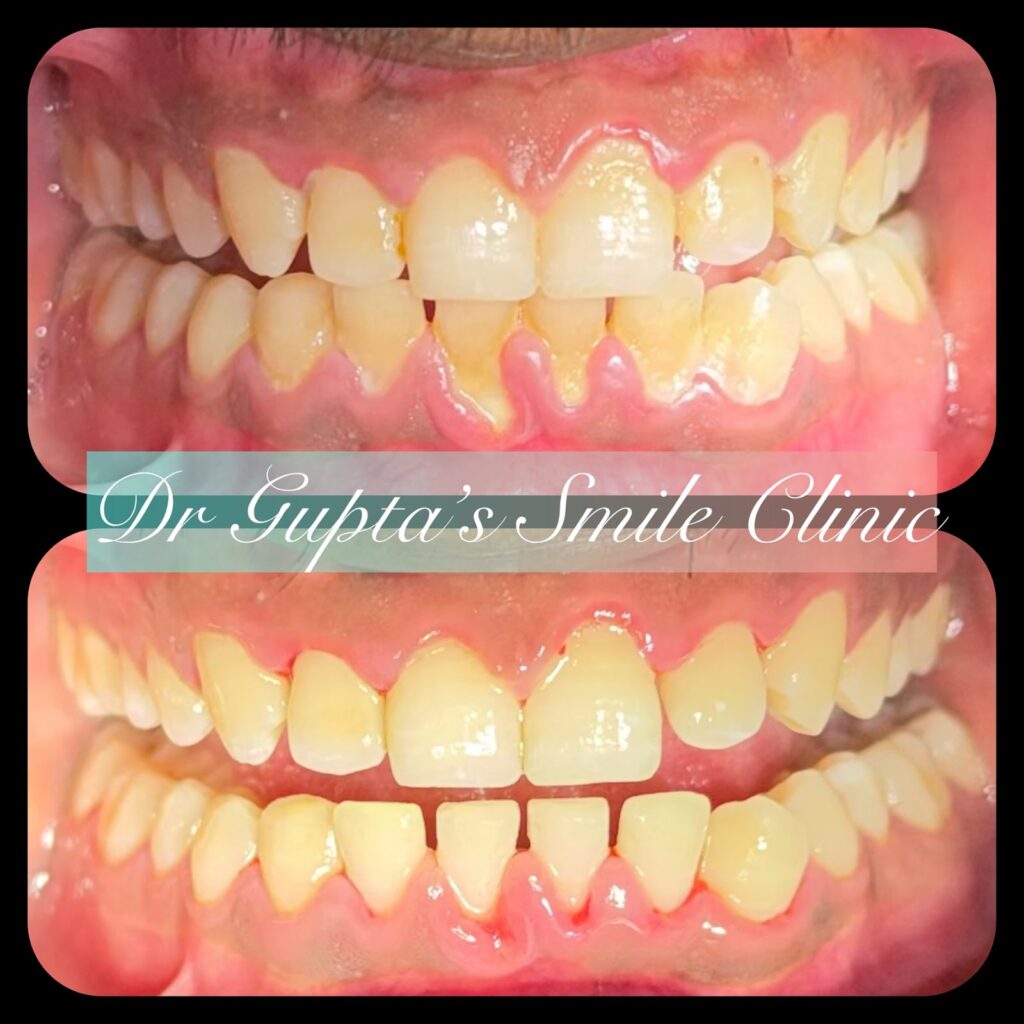 Gum and scaling treatment result at Dr. Gupta's Smile Clinic
