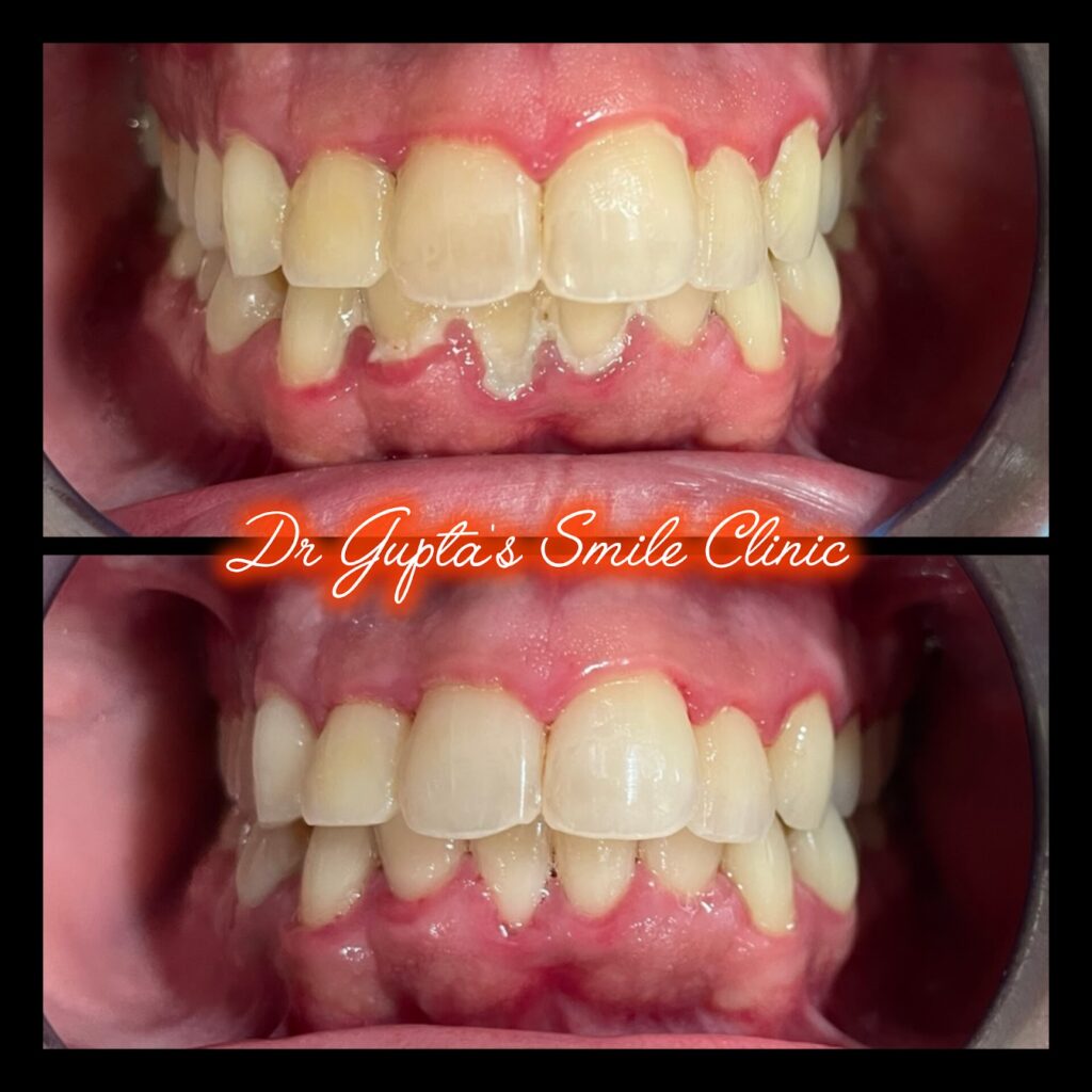 Gum treatment result at Dr. Gupta's Smile Clinic, Zirakpur