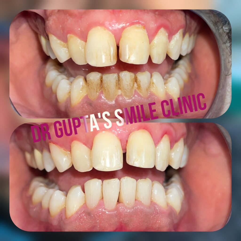Healthier gums after treatment, before and after