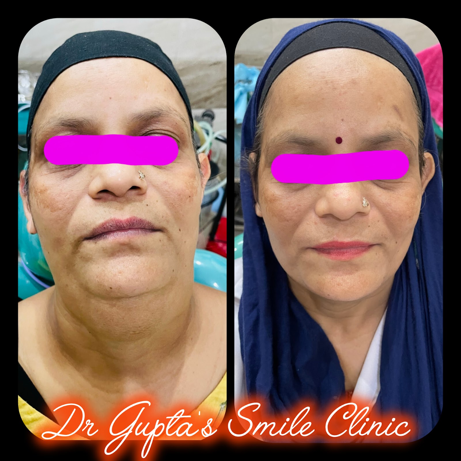Oral surgery result before and after at Dr. Gupta's Smile Clinic