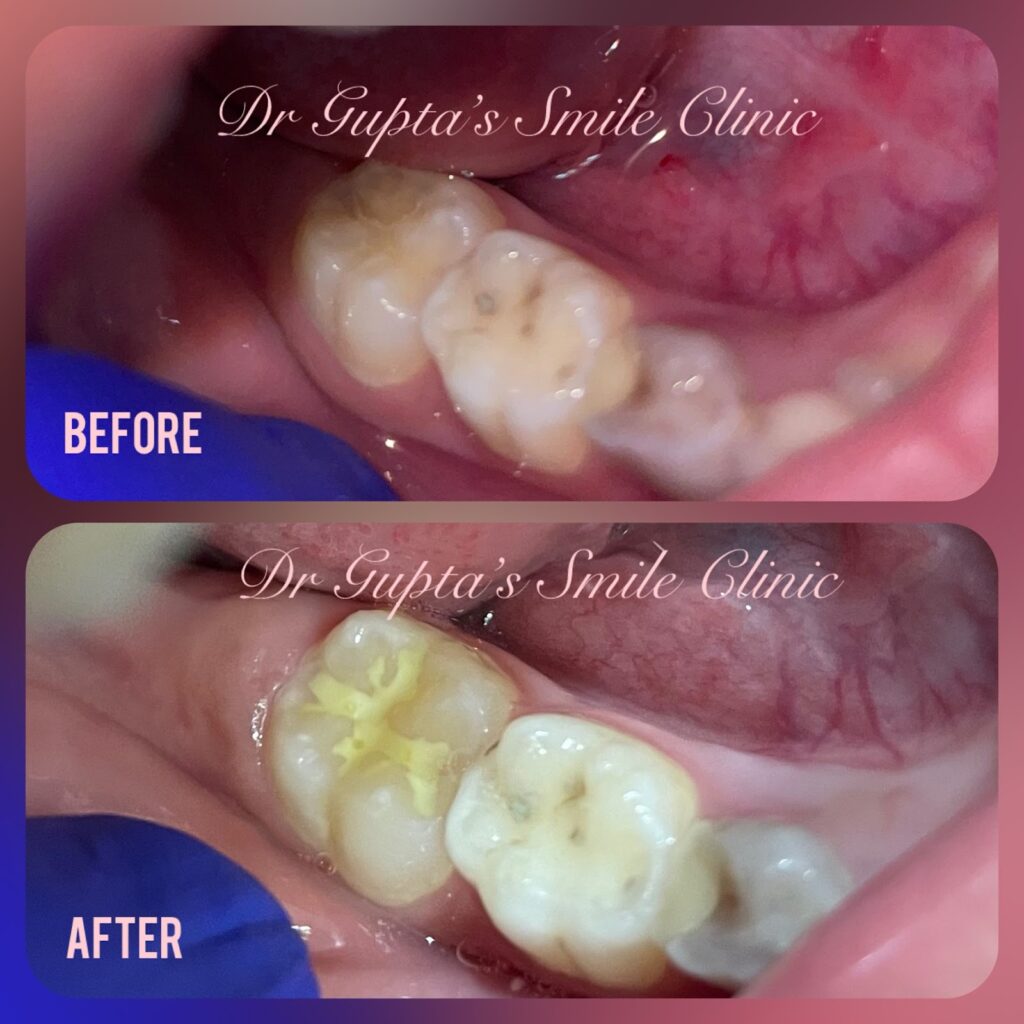 Pit and fissure sealants before and after for a child