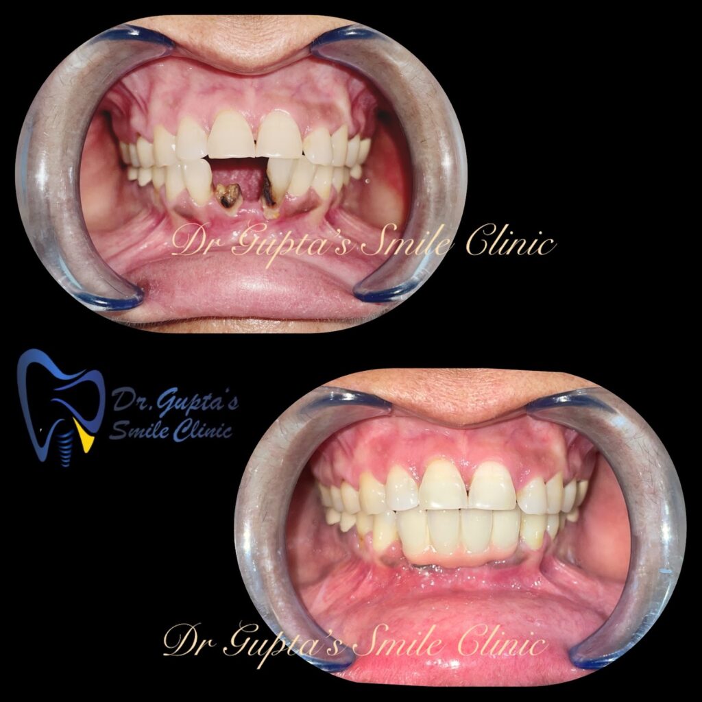 Smile restored with dental implants at Dr. Gupta's Smile Clinic, Zirakpur