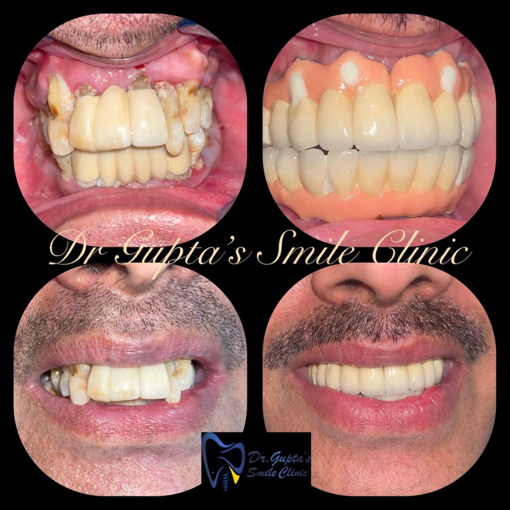 Function and smile restored with dental implants, before and after