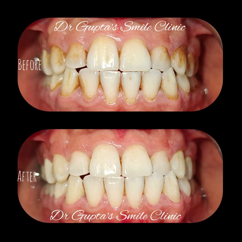 Scaling and polishing result at Dr. Gupta's Smile Clinic