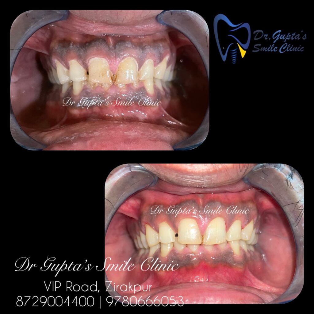 Scaling and polishing before and after at Dr. Gupta's Smile Clinic