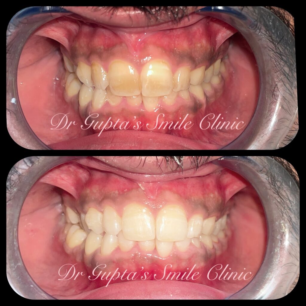 Teeth cleaning result at Dr. Gupta's Smile Clinic, Zirakpur