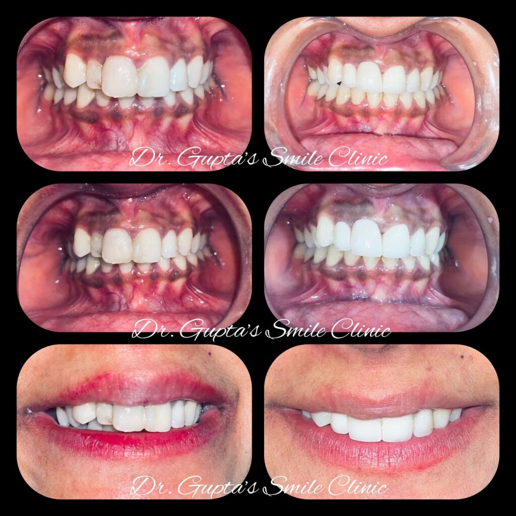 Smile correction with crowns, before and after at Dr. Gupta's Smile Clinic
