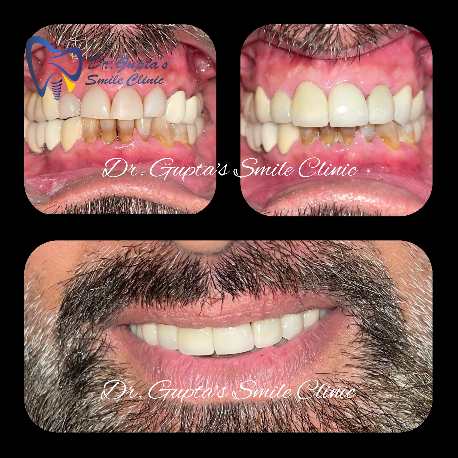 Smile correction with crowns, before and after