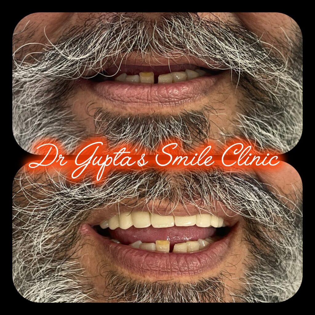 Smile makeover with dental implants at Dr. Gupta's Smile Clinic, Zirakpur