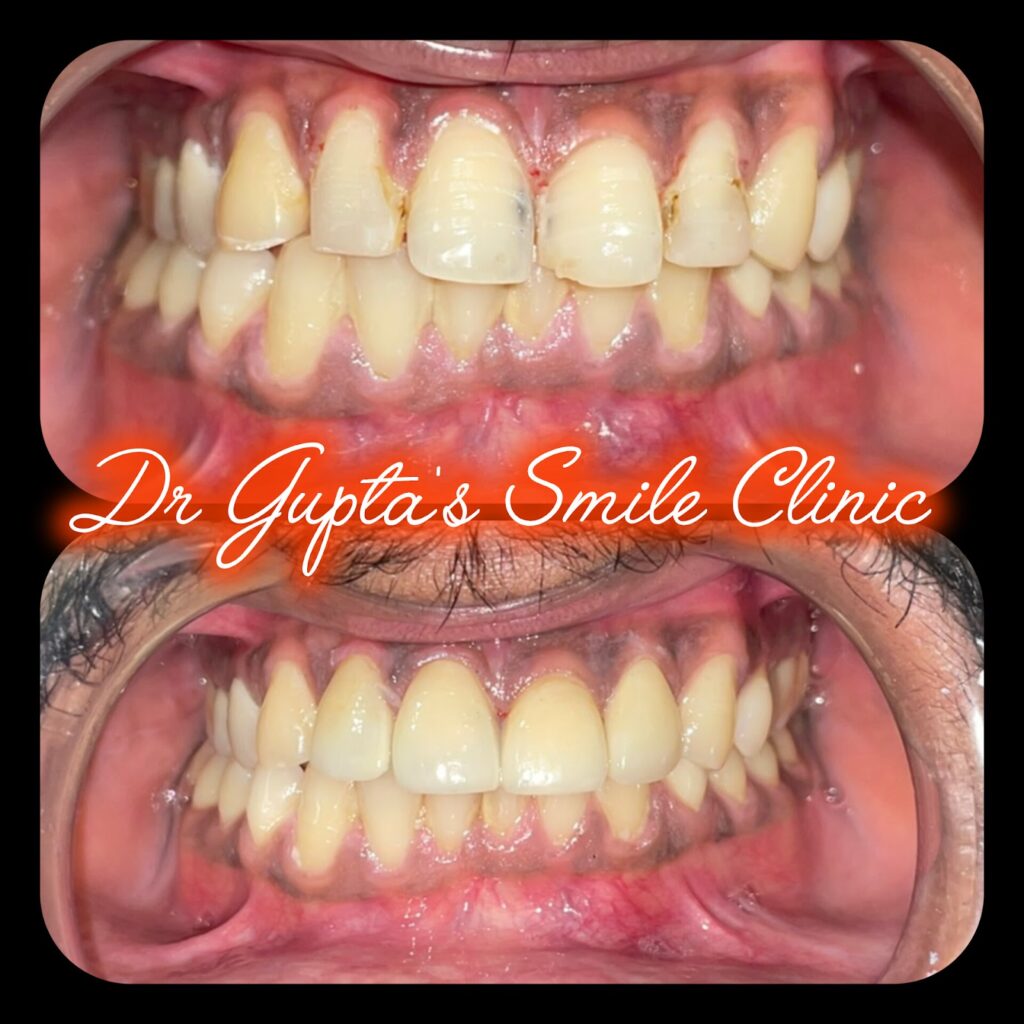 Veneers before and after at Dr. Gupta's Smile Clinic, Zirakpur