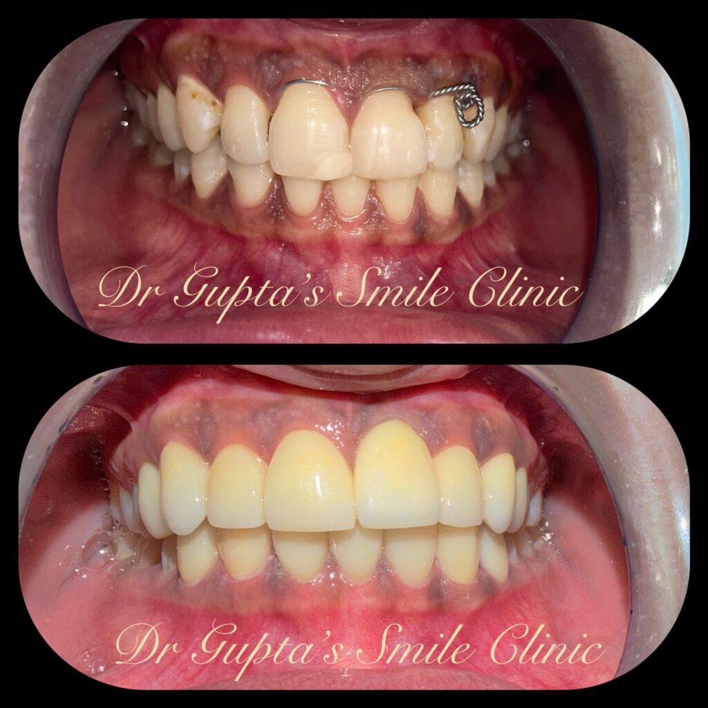 Smile with veneers at Dr. Gupta's Smile Clinic, Zirakpur