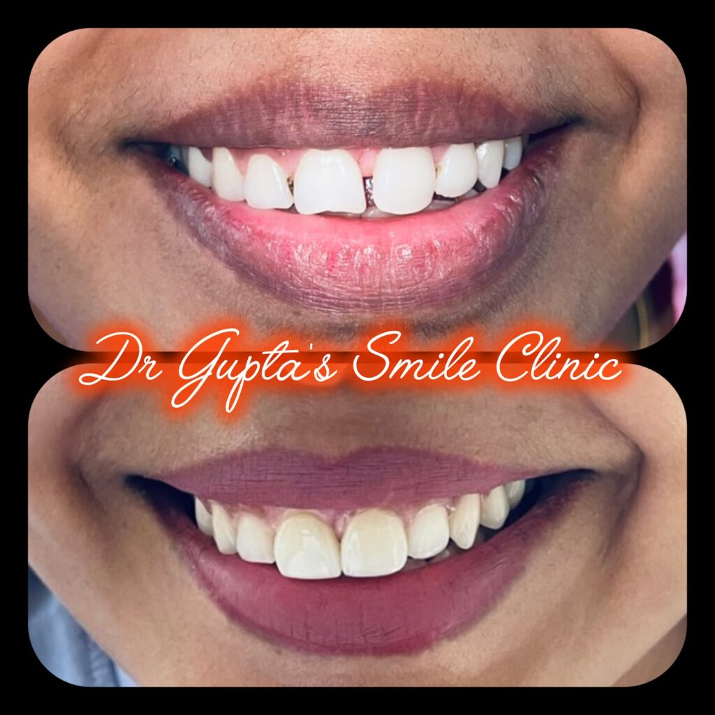 Veneers smile makeover result at Dr. Gupta's Smile Clinic