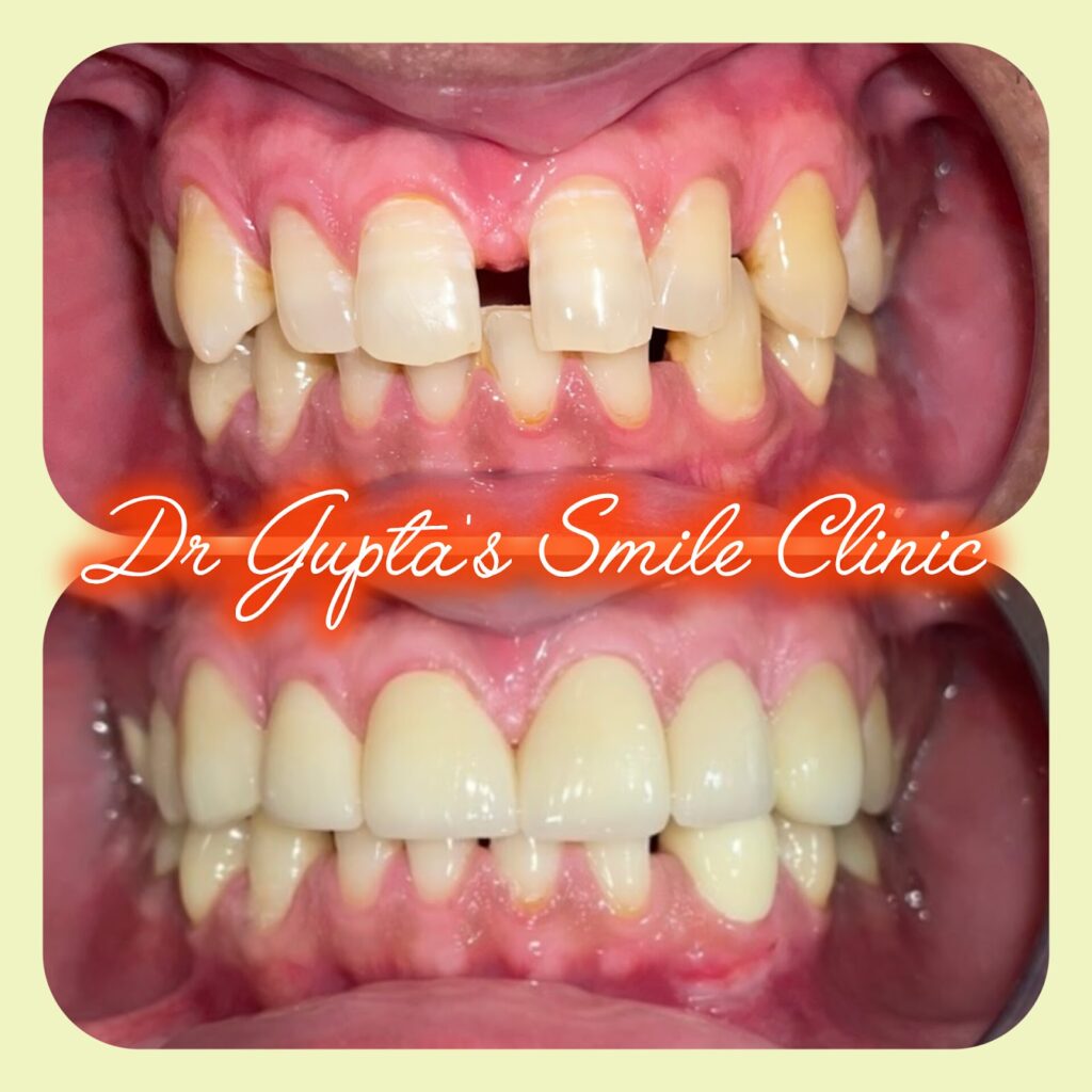 Gap closure with veneers at Dr. Gupta's Smile Clinic